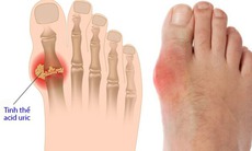 7 thảo mộc giúp giảm axit uric hiệu quả