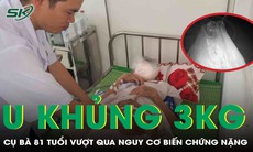 Cắt u buồng trứng 3kg cứu cụ bà 81 tuổi thoát biến chứng nặng