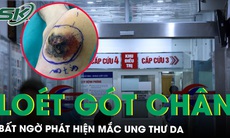 Loét gót chân kéo dài 6 tháng bất ngờ phát hiện mắc ung thư da