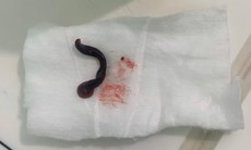 Con vắt dài 4cm sống trong mũi người đàn ông
