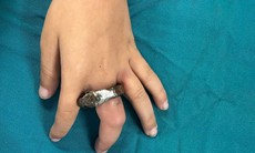Vòng khóa siết ngón tay bé trai, gia đình cưa cửa mang đến viện