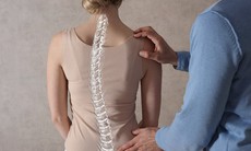 Thuốc điều trị vẹo cột sống