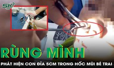 Đi khám vì chảy máu mũi, bé trai khiến bác sĩ rùng mình khi gắp ra “dị vật” 