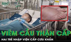 Phù mặt, sưng chân không rõ nguyên nhân, hai trẻ nhập viện khẩn viêm cầu thận cấp
