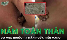 Tự ý mua thuốc trên mạng điều trị mẩn ngứa, người đàn ông bị nấm toàn thân
