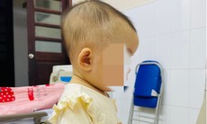 Bé 7 tháng tuổi tụ máu dưới da đầu từ cú ngã tưởng như vô hại