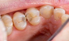 Những dấu hiệu cảnh báo cơ thể thiếu canxi người Việt dễ bỏ qua