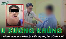 Mắc u xương khổng lồ, chàng trai 24 tuổi mặt biến dạng, không thể ăn uống như bình thường
