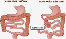 Đau bụng cảnh giác với xoắn ruột cần nhập viện khẩn cấp