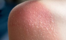 Cách khắc phục làn da bị cháy nắng