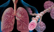 Những lưu ý quan trọng cho người bệnh hen phế quản 