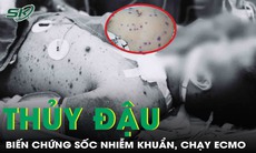 Biến chứng thủy đậu: Một ca xin về vì sốc kháng trị, một ca phải lọc máu, chạy ECMO
