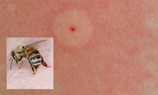 Bé 3 tuổi bị sốc phản vệ độ 3, suy hô hấp do ong đốt