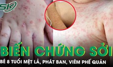 Bé trai 8 tuổi mắc sởi biến chứng viêm phế quản 