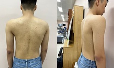 Tin vui cho trẻ mắc bệnh lý gù, vẹo cột sống