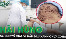 Hãi hùng da lỗ chỗ như tổ ong vì đắp đậu xanh chữa zona thần kinh