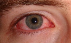 Đỏ mắt cảnh giác với viêm màng bồ đào