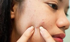 Sau nặn mụn không nên ăn gì?