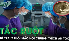 Bé trai 7 tuổi tắc ruột do hội chứng ‘thích ăn tóc’ 