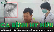 Ca bệnh hy hữu: Mảnh xương sắc nhọn cắm sâu trong phế quản suốt 5 tháng 