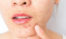 Mụn trứng cá có tự chữa được không?