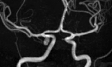 Cân nhắc chẩn đoán trong liệt dây thần kinh số III mắc phải, đơn thuần