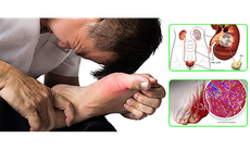 Bệnh gout ảnh hưởng thế nào đến tim, thận?