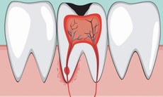 Viêm tủy răng ở trẻ có biểu hiện gì, hệ lụy ra sao?