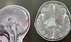 Cứu sống bé trai 2,5 tuổi bị huyết khối nội sọ do rối loạn chuyển hóa hiếm gặp