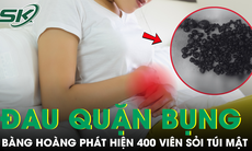 Sống chung với đau bụng âm ỉ, người phụ nữ không ngờ có gần 400 viên sỏi túi mật