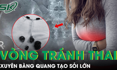 Tưởng viêm đơn thuần, hóa ra vòng tránh thai xuyên thủng bàng quang tạo sỏi 