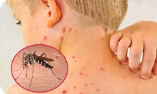 Cách phát hiện sớm sốt xuất huyết diễn biến nặng