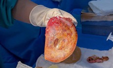 Điều trị co thắt bao xơ sau nâng ngực