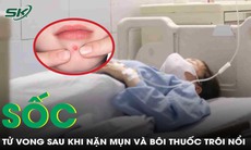 Sốc: Nữ sinh Hà Nội tử vong sau khi nặn mụn và bôi thuốc không rõ nguồn gốc