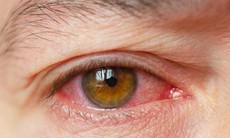 Thêm liệu pháp mới điều trị bệnh khô mắt