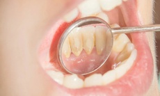 Cách nhận biết cao răng đang tích tụ