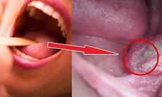 Dấu hiệu điển hình của ung thư khoang miệng ở giai đoạn sớm