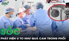 Sốc nặng khi phát hiện khối u to như quả cam trong phổi
