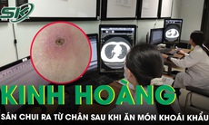 Kinh hoàng: Sán chui ra từ chân hai anh em sau bữa ăn món khoái khẩu 
