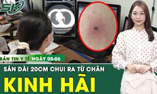 Bản tin Y tế 5/6: Kinh hãi giun sán chui ra từ chân 2 anh em do ăn món khoái khẩu 
