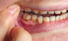 Có nên lấy cao răng tại nhà?