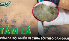Tắm lá chữa sởi nam thanh niên viêm da bội nhiễm toàn thân