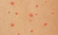 Cẩn trọng với bệnh thủy đậu gây biến chứng