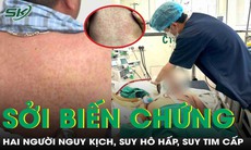 Hai bệnh nhân nguy kịch vì mắc sởi biến chứng viêm phổi nặng, suy tim cấp 

