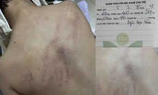 Cục Bà mẹ và Trẻ em lên tiếng về vụ trẻ bị bạo hành ở Hà Nội