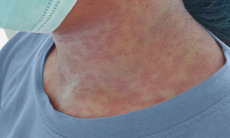 Nguy cơ mắc rubella: Cảnh báo với nhóm phụ nữ mang thai và trẻ nhỏ