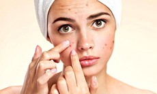 Cách xử lý mụn trứng cá, phục hồi làn da khỏe mạnh sau mụn