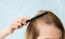 Dấu hiệu nhận biết sớm hói đầu và những lầm tưởng phổ biến