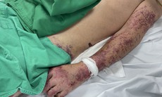 Đã có người tử vong vì nhiễm liên cầu lợn, Bộ Y tế khuyến cáo 6 cách phòng, chống bệnh