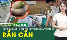 Bản Tin Y Tế 18/7: Bị rắn hổ mang chúa cắn, người đàn ông ngừng tim, hôn mê sau đắp thuốc lá